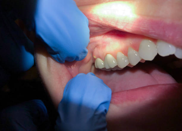 Best Lost Filling or Crown Replacement in Cresson, PA